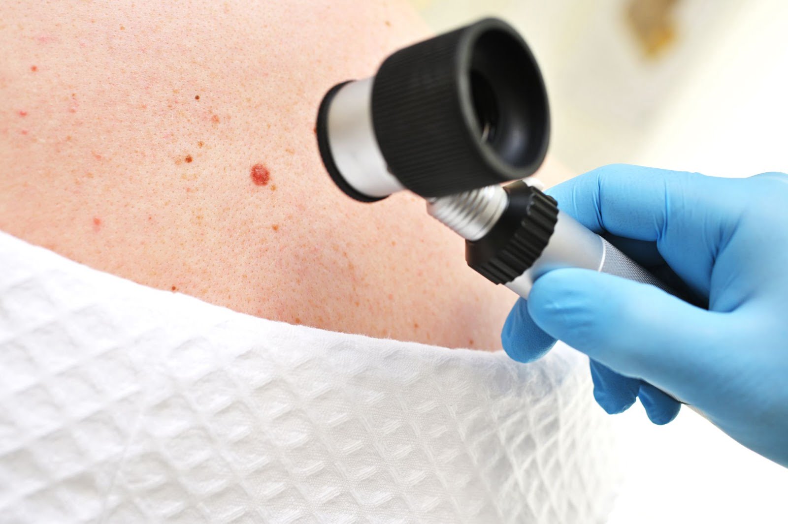 Skin Tag Removal Guide