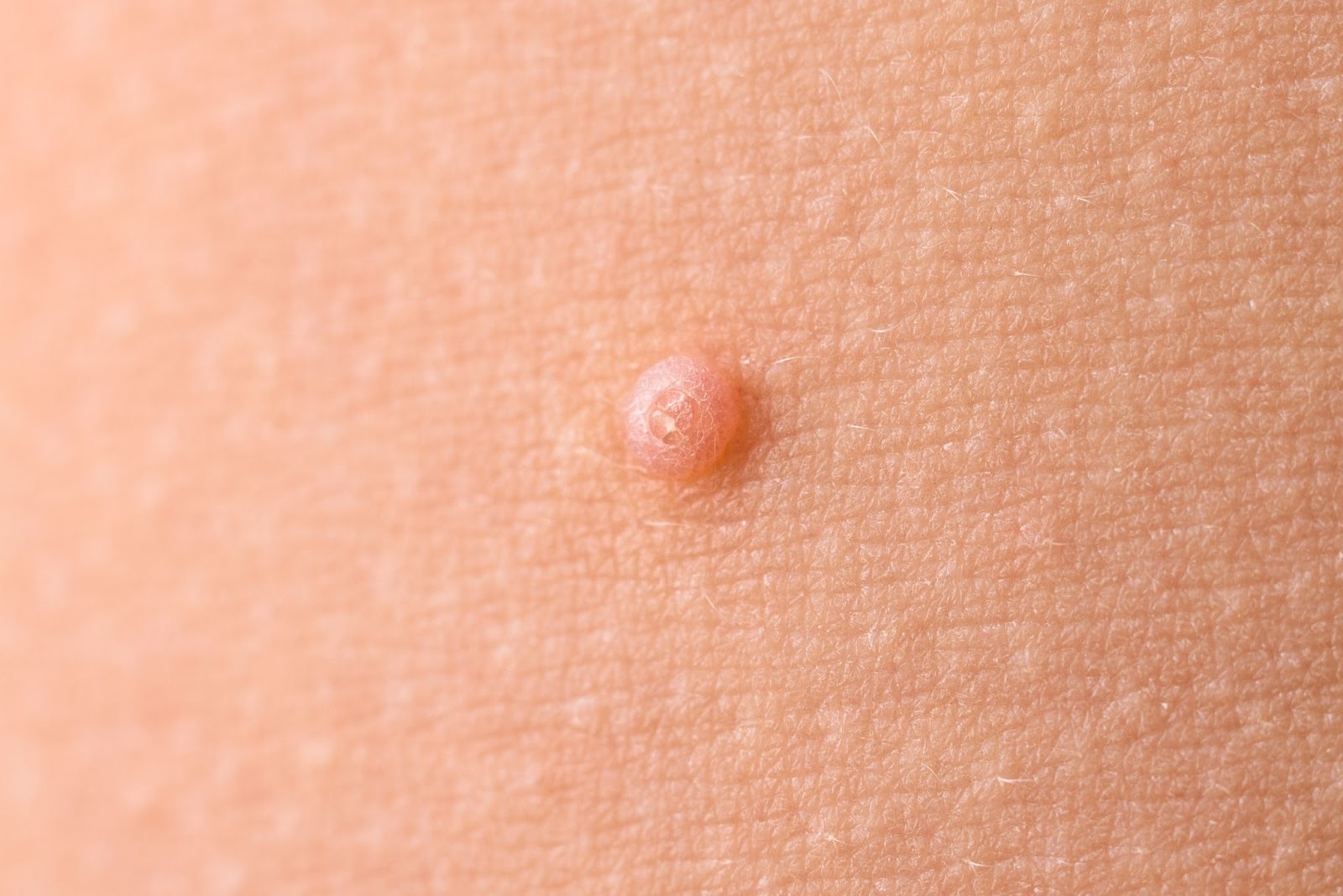 Skin Tag Removal Guide