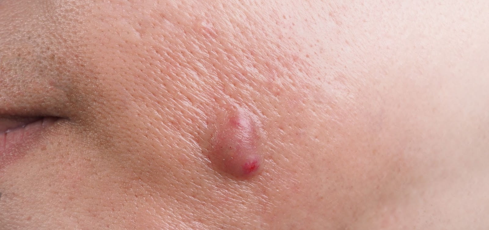 Skin Tag Removal Guide