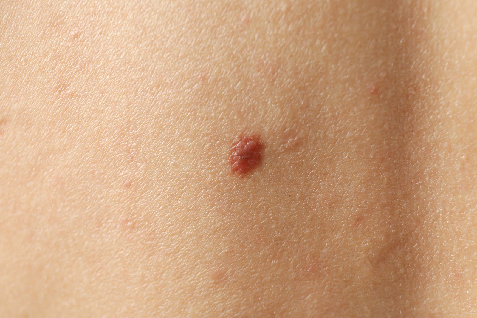 Skin Tag Removal Guide