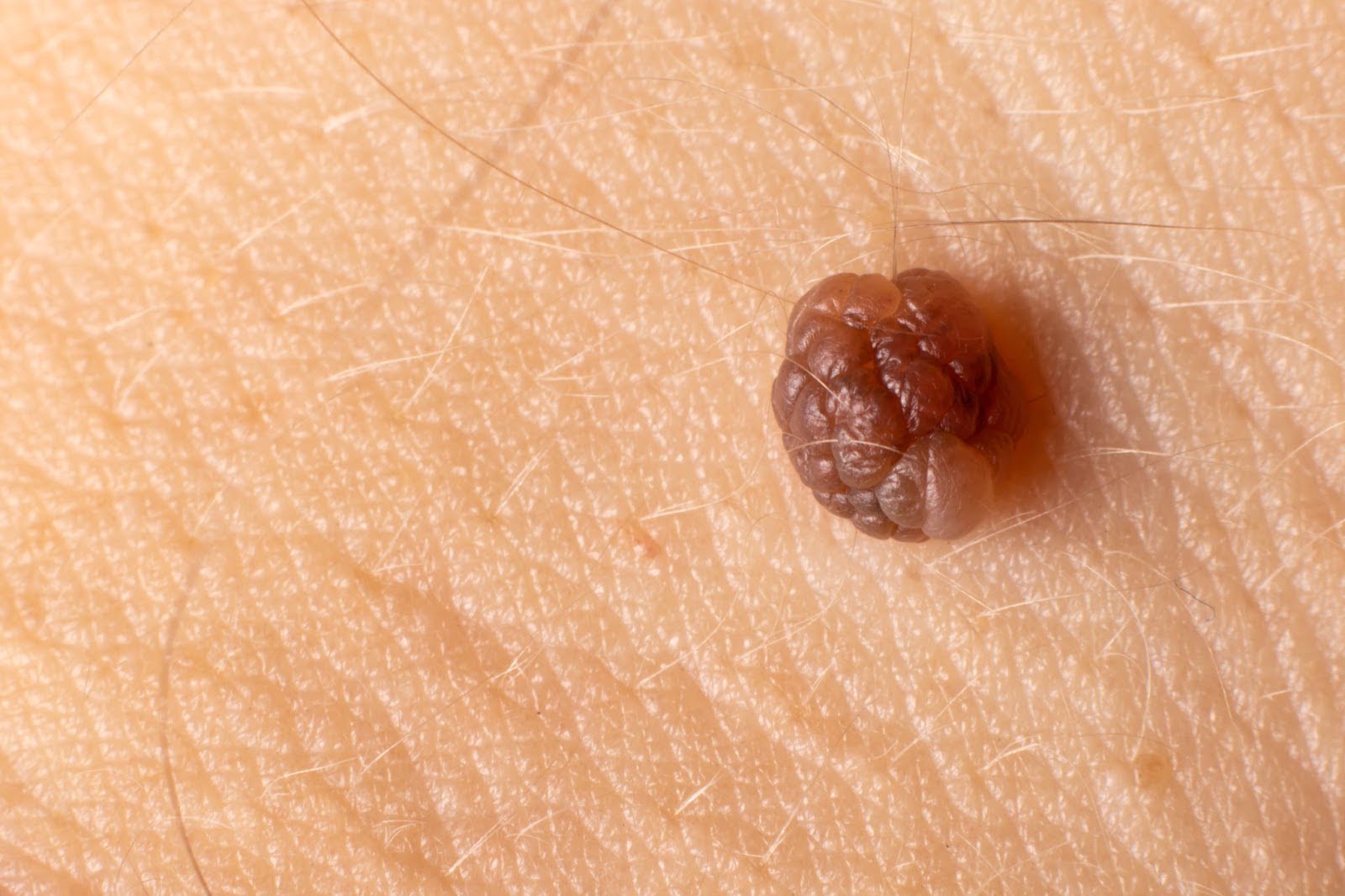 removing skin tags