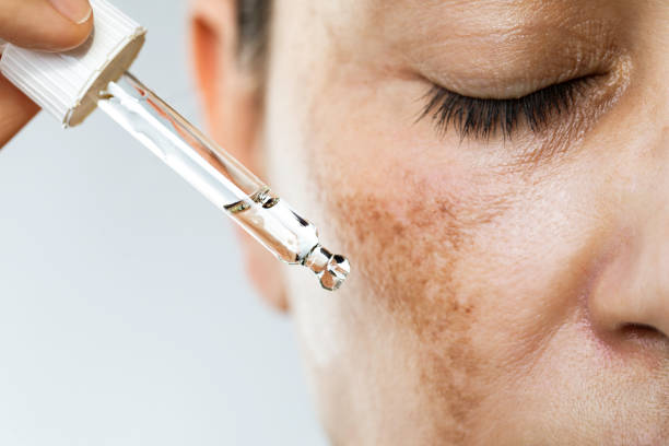 Hyperpigmentation treatment