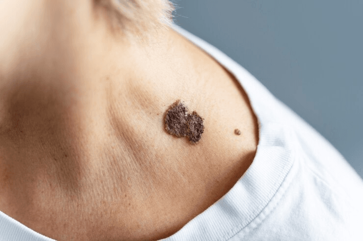 skin mole removal