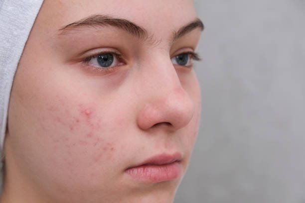 Hormonal pigmentation treatment