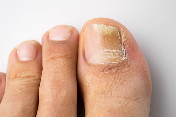 signs of nail fungus