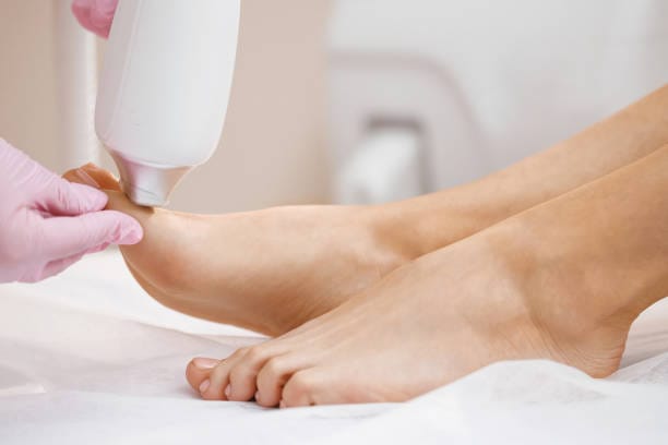 Nail Fungus Laser Treatment