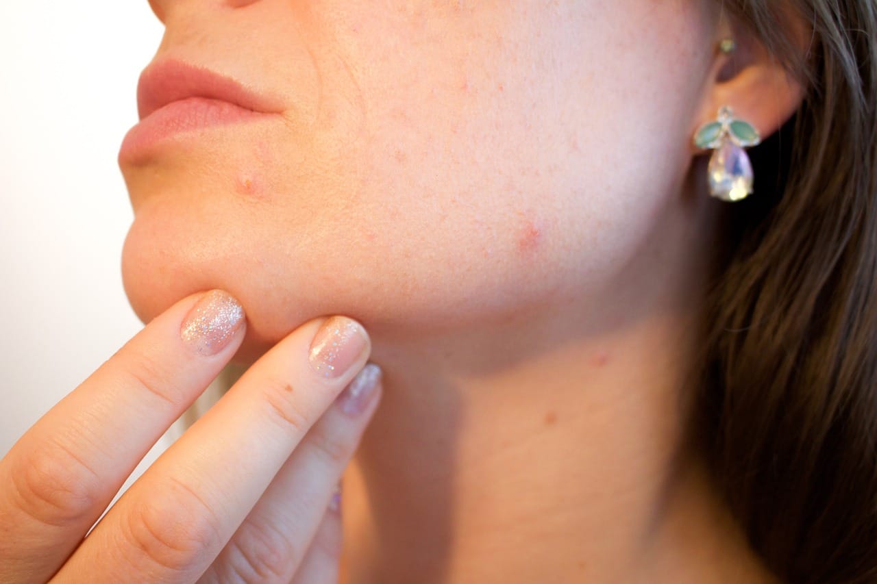 Glutathione Injections For Acne Scars