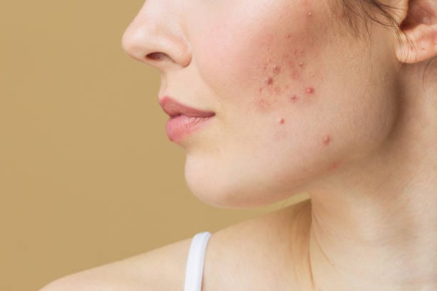 Glutathione Injections For Acne Scars