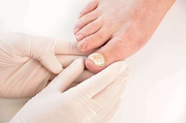 Best Nail Fungus Treatments