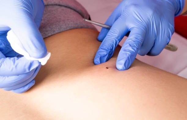 electrosurgery for wart removal