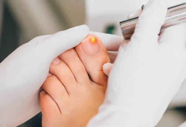 Toenail Fungus Treatment Clinic