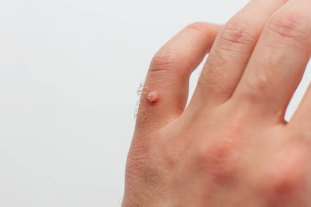 wart removal for sensitive skin