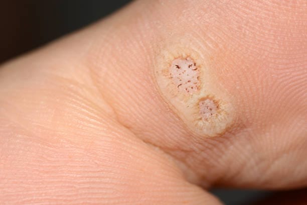 Plantar wart removal