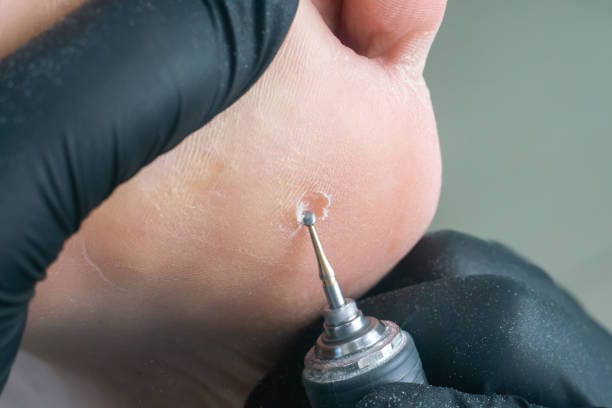 Surgical Wart Removal