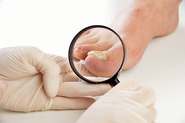 Toenail Fungus Treatment Clinic