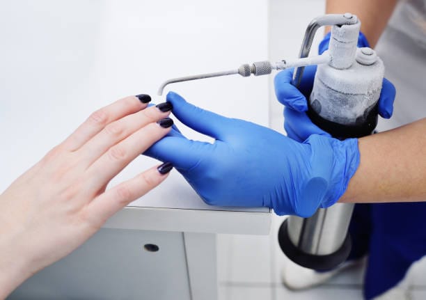 cryotherapy for wart removal