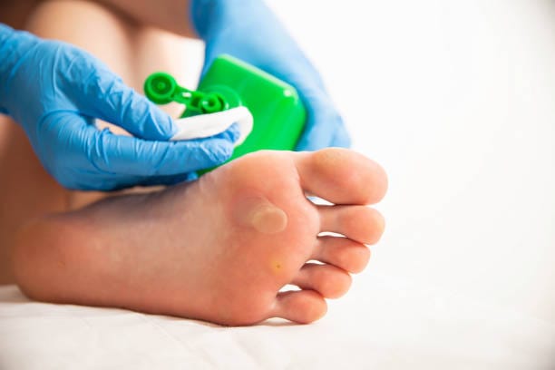 plantar wart removal in Manchester