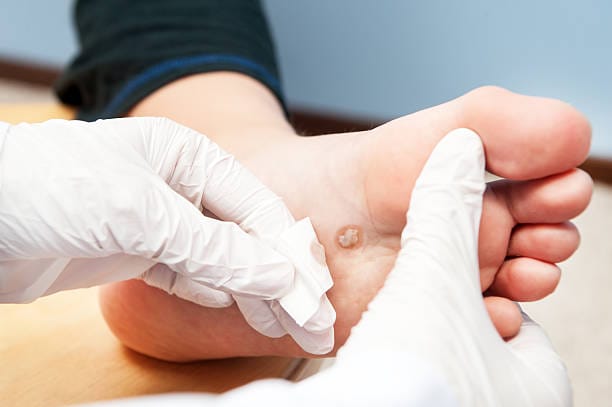 Wart removal cost Manchester