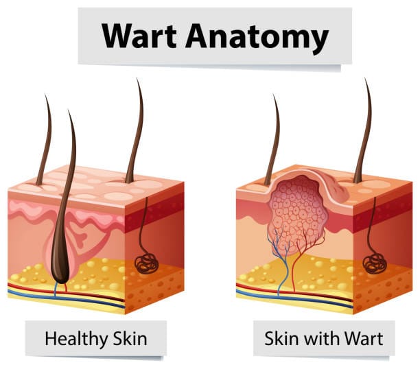 causes of warts