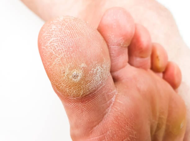 plantar wart removal in Manchester