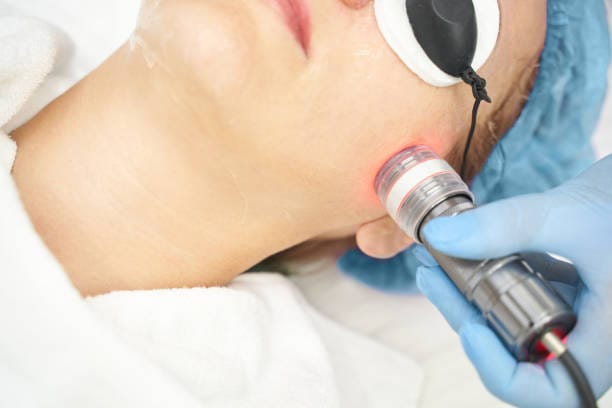 Laser Wart Removal Manchester