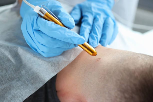 Cryotherapy for Mole Removal