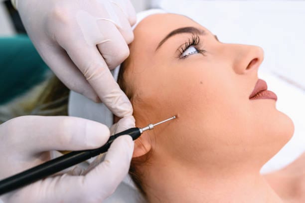  Facial Mole Removal